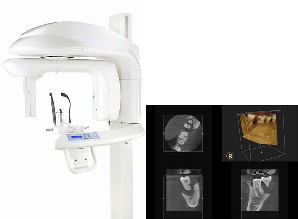 歯科用ＣＴ