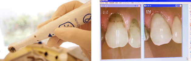 口腔内カメラ 口腔内カメラ